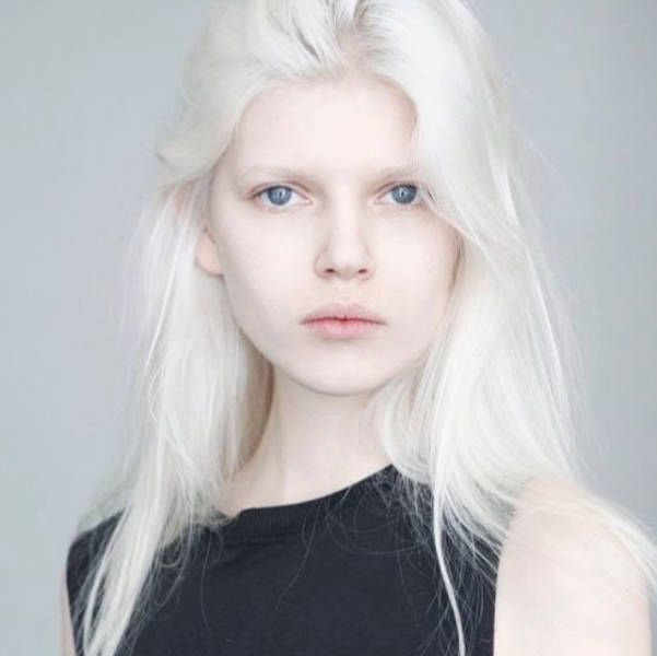 How Albinos From Various Races Look Like