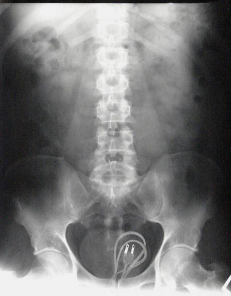 X-Rays of Objects Stuck in Really Strange Places